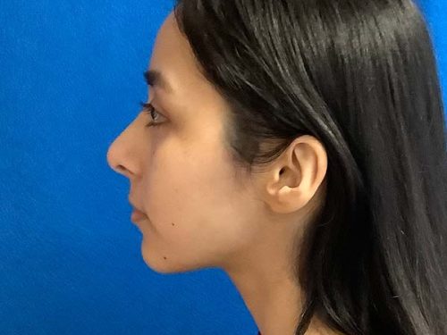 Rhinoplasty before and after - after