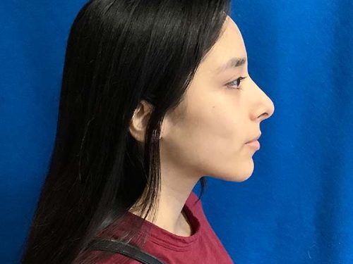 Rhinoplasty before and after - after