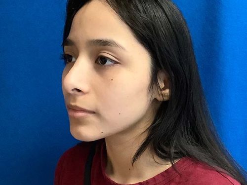 Rhinoplasty before and after - after