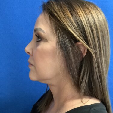 Facelift before and after - after