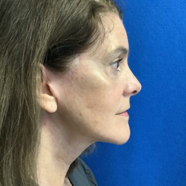 Facelift before and after - after