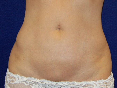 Liposuction before and after - after