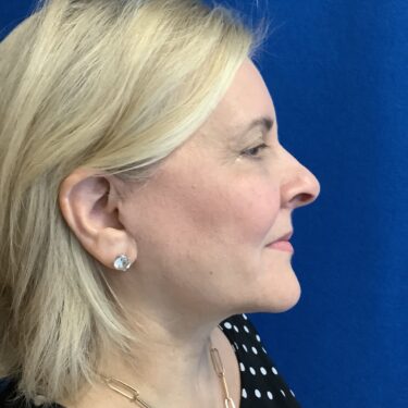 Facelift before and after - after