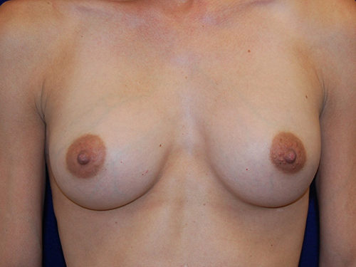 Breast Augmentation before and after - after