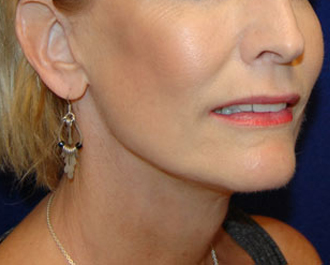 Facelift before and after - after