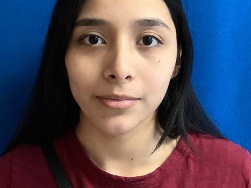 Rhinoplasty before and after - after