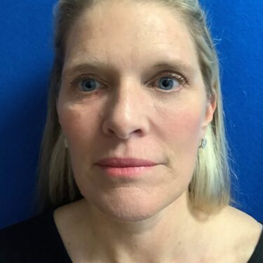 Facelift before and after - after