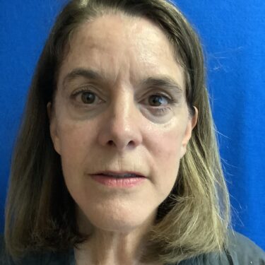 Facelift before and after - after