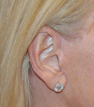 Procedure before and after - after