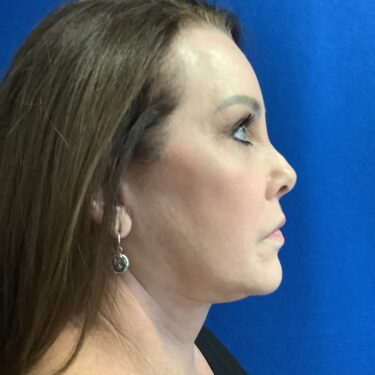 Facelift before and after - after