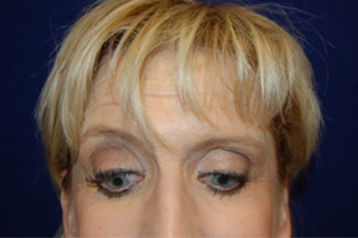 Blepharoplasty before and after - after