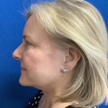 Facelift before and after - after