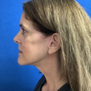 Facelift before and after - after