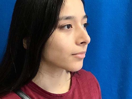 Rhinoplasty before and after - after