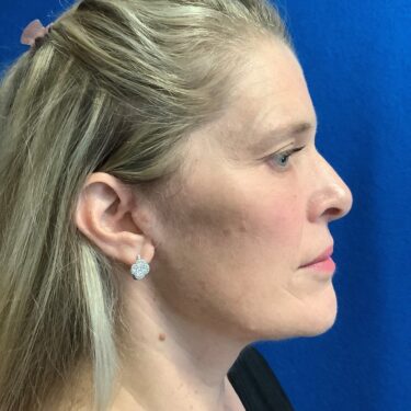 Facelift before and after - after