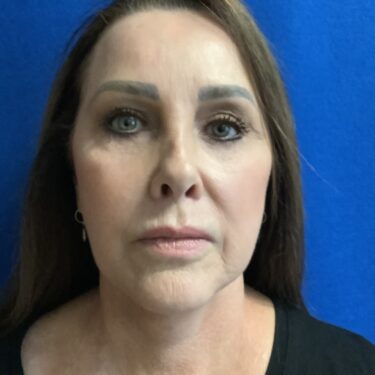 Facelift before and after - after