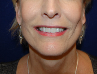 Facelift before and after - after