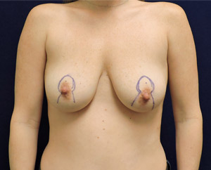 Breast Lift before and after - before