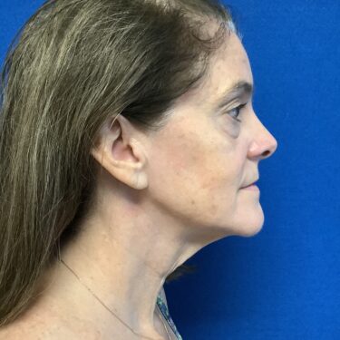 Facelift before and after - before