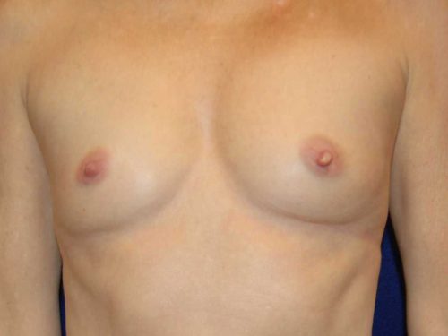 Breast Augmentation before and after - before