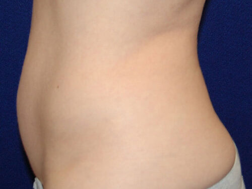 Liposuction before and after - before