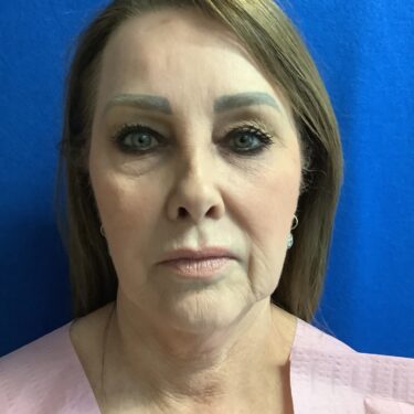 Facelift before and after - before