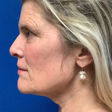 Facelift before and after - before