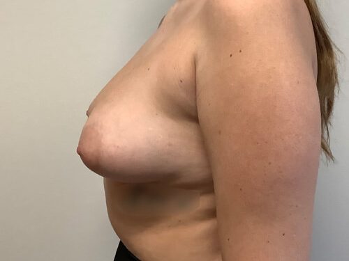 Breast Augmentation before and after - before
