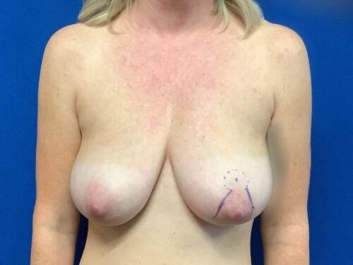 Breast Lift before and after - before