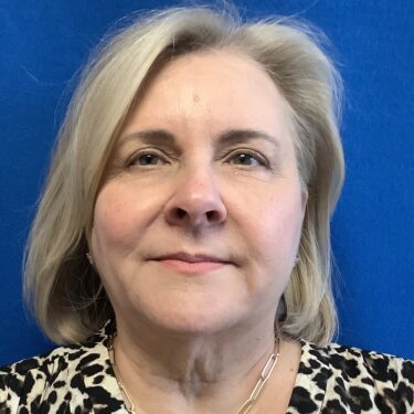 Facelift before and after - before
