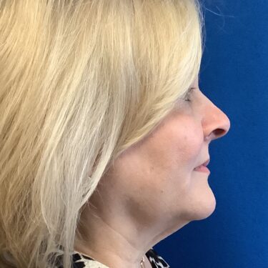 Facelift before and after - before