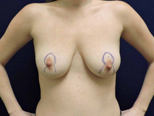 Breast Lift before and after - before