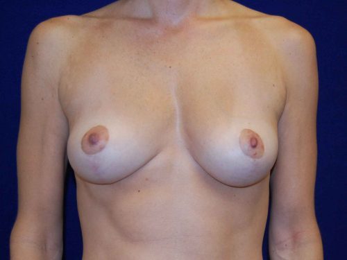 Breast Lift before and after - before