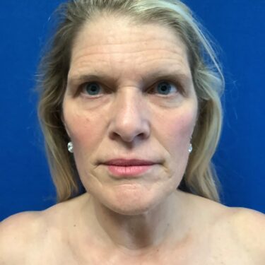 Facelift before and after - before