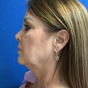 Facelift before and after - before