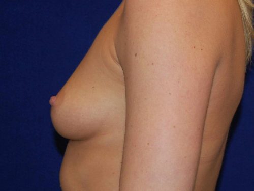 Breast Augmentation before and after - before