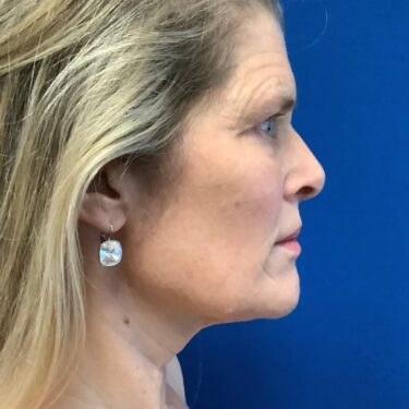 Facelift before and after - before