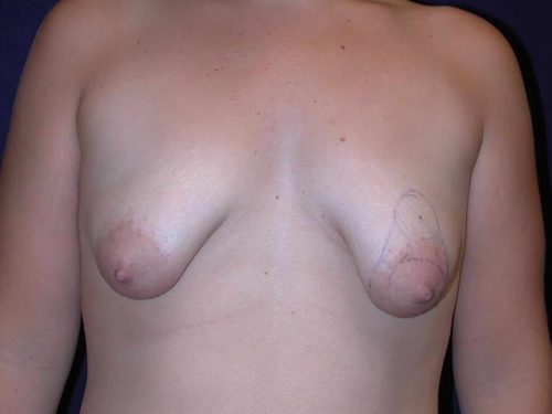 Procedure before and after - before