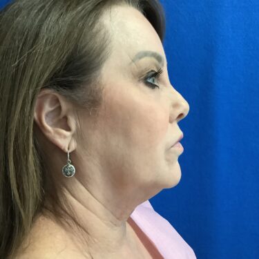 Facelift before and after - before