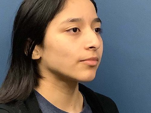 Rhinoplasty before and after - before