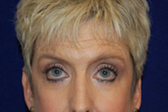 Blepharoplasty before and after - before