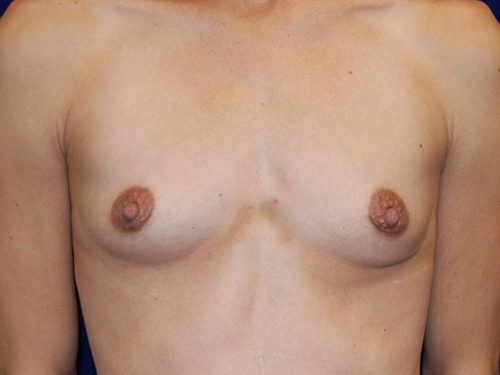 Breast Augmentation before and after - before