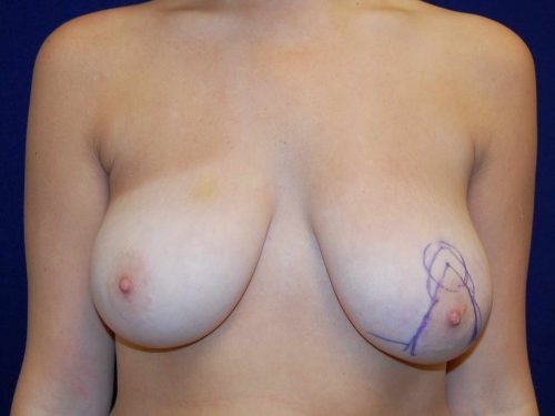 Breast Reduction before and after - before