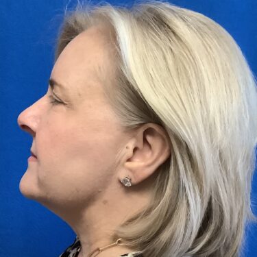 Facelift before and after - before