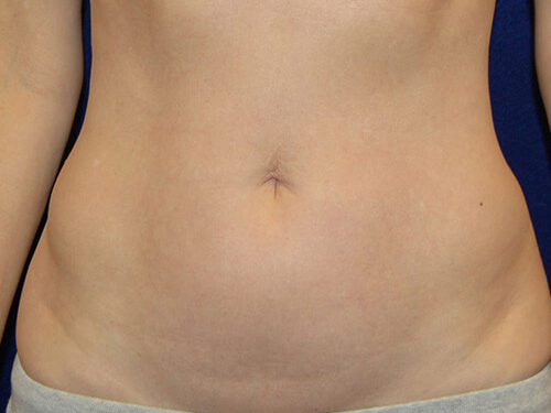 Liposuction before and after - before