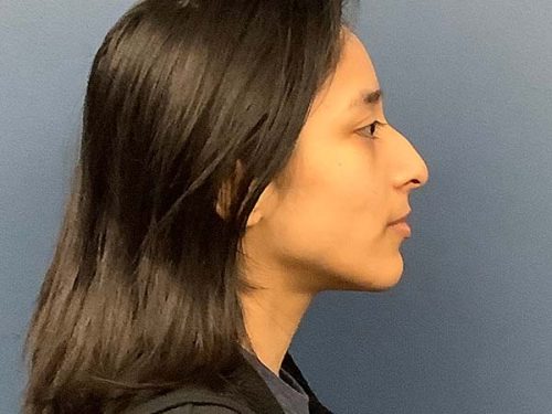 Rhinoplasty before and after - before
