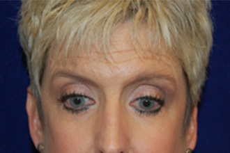 Blepharoplasty before and after - before