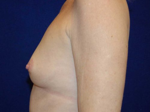 Breast Augmentation before and after - before