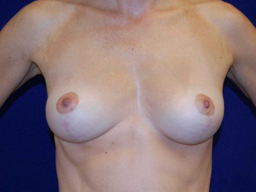 Breast Lift before and after - before