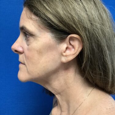 Facelift before and after - before